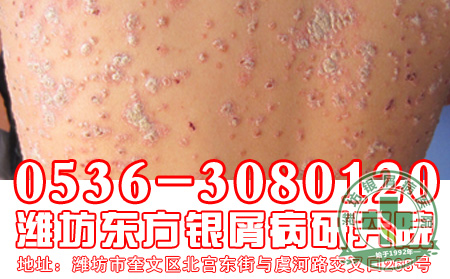 银屑病有哪些患者必须要注意的危害?