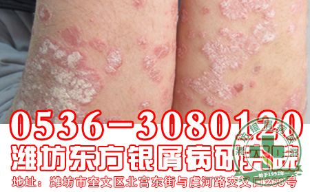银屑病的治疗过程中要注意什么问题?