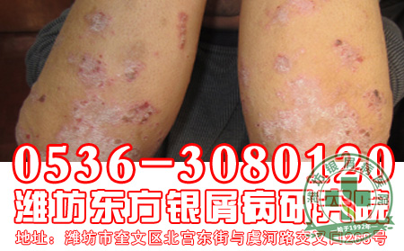 银屑病的初期症状是什么样子的？