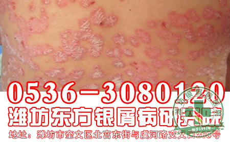 银屑病患者的药物使用要注意什么问题?