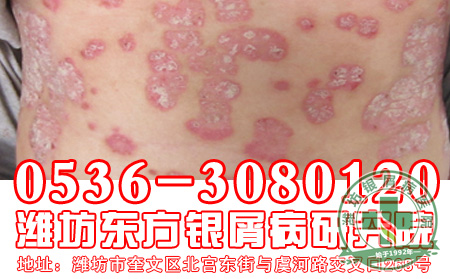 银屑病患者怎样用药有助于减少副作用?