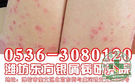 银屑病患者在用药的时候要注意什么？