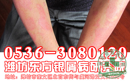 对于银屑病的传染问题患者要知道什么?