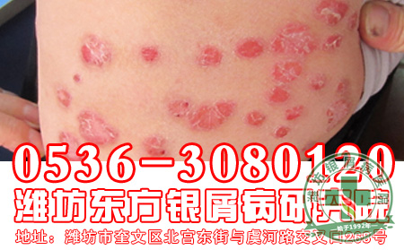 银屑病患者常发的症状变现有哪些？