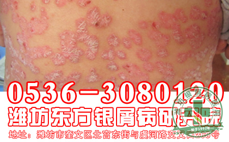 银屑病患者的饮食应该注意哪些事情?