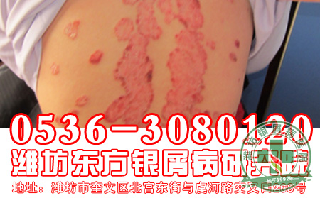 牛皮癣用药要注意到哪些事情?
