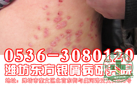 牛皮癣有什么症状的表现？