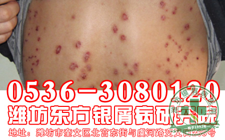 牛皮癣的防护工作应该做到那些？
