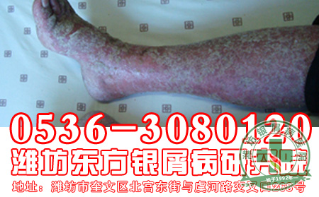 患者对于红皮型银屑病这种严重银屑病类型，应