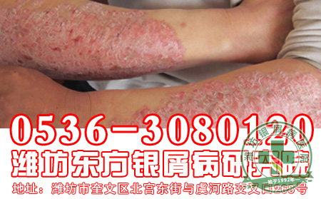 对于银屑病的发病症状表现,患者应该如何应对