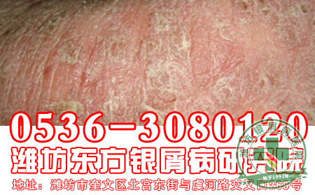 银屑病患者的饮食工作要怎样做好？