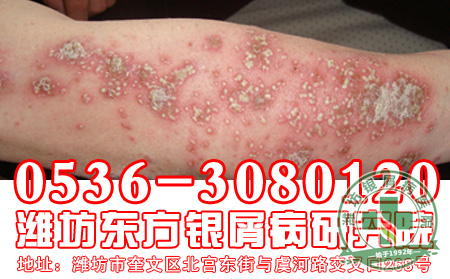 怎样正确对待银屑病患者的心理精神因素?