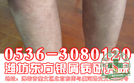 银屑病患者的心理治疗工作应该怎么做?