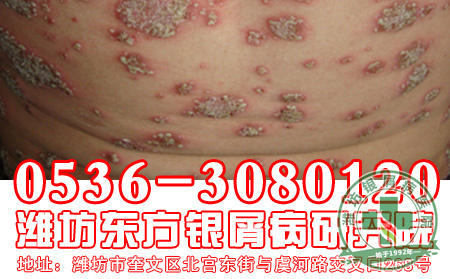 红皮型银屑病注意哪些呢?