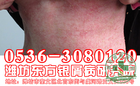 红皮型牛皮癣的饮食工作要注意什么？