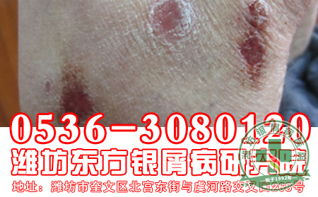 牛皮癣发病后的面部治疗要注意什么?