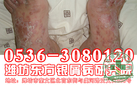 银屑病的发病阶段有什么表现？