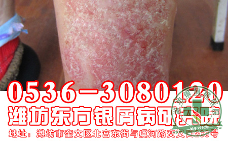 红皮型牛皮癣患者应该怎样注意牛皮癣的治疗?