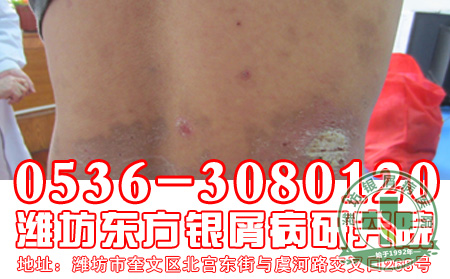 外伤为什么也会引发银屑病出现？
