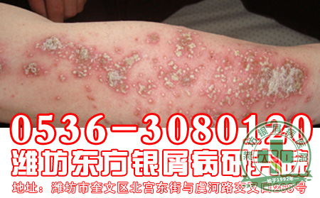 秋季到了患者要怎样治疗银屑病？