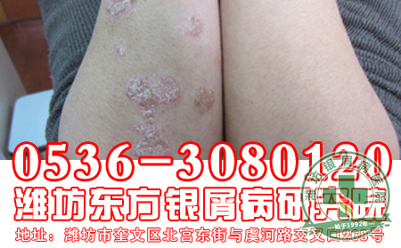 银屑病患者应该吃什么?不吃什么?