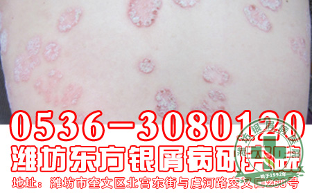 银屑病患者应该怎样注意对于药物的使用？