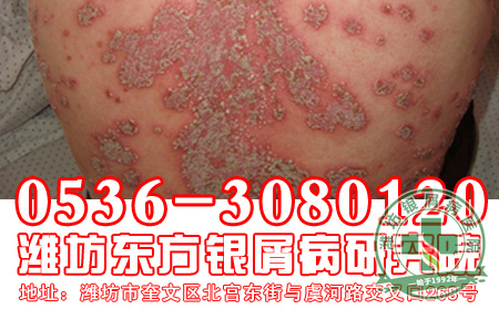 银屑病患者的饮食工作应该怎样做好忌口？