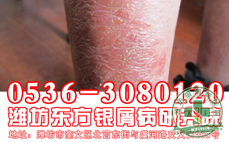 银屑病患者的心理因素要注意什么问题？