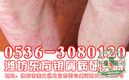 患者你知道牛皮癣发病后会出现的症状吗?
