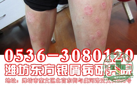 银屑病患者辅助治疗银屑病应该注意吃什么?