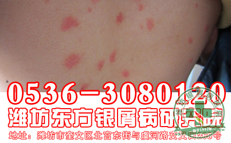 寻常型银屑病的发病症状是怎么样的？