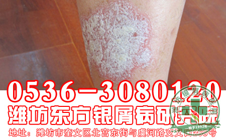 牛皮癣患者的偏方使用要注意的问题有什么?
