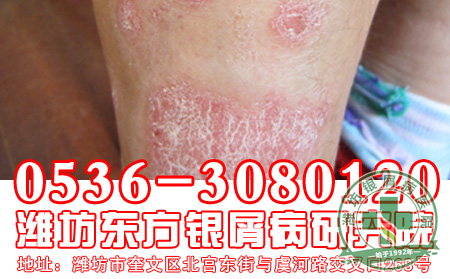 秋季到了,银屑病患者的饮食工作应该怎么做?