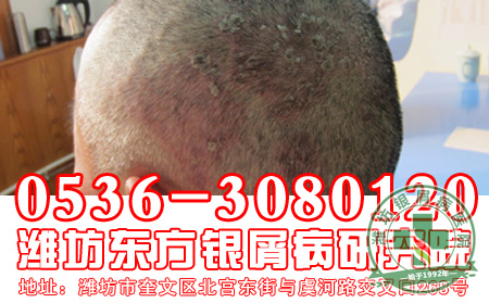 头部出现银屑病后患者要怎么治疗?