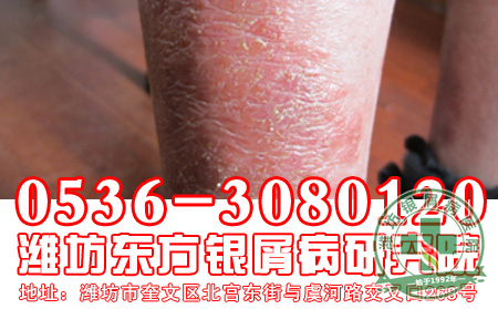 红皮型银屑病的发病症状是怎么样的?