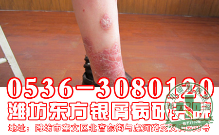 脓疱型银屑病的治疗要注意的问题有哪些?