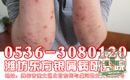 银屑病的治疗要注意的问题有哪一些?