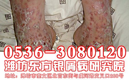 老年牛皮癣发病的表现是什么样的?