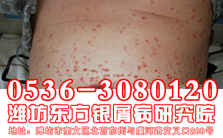 怎样做有助于牛皮癣患者避免复发