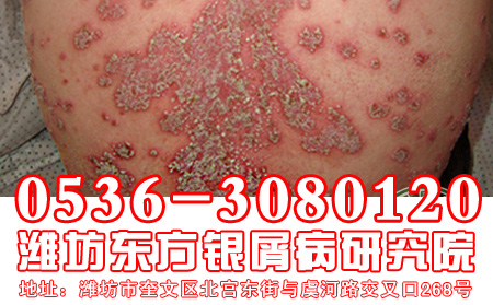 怎样注意做好牛皮癣的防复发工作?