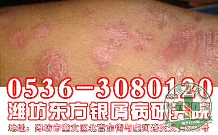 牛皮癣会给患者的身体造成哪些危害?