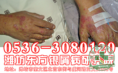 重型牛皮癣的发病症状是什么？