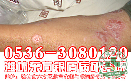 牛皮癣的偏方使用要注意什么问题?
