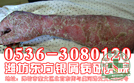 银屑病的心理因素为什么要做好调理?