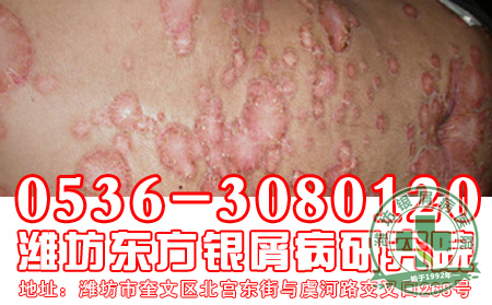 银屑病治疗要怎样使用偏方？