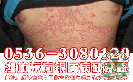 银屑病发病后的护理工作要注意什么？