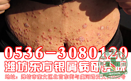 银屑病的治疗要如何注意药物的使用？