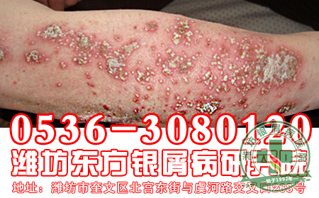 银屑病发病后会给患者造成什么伤害?