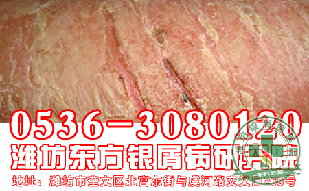 生活中哪些行为对银屑病有危害？