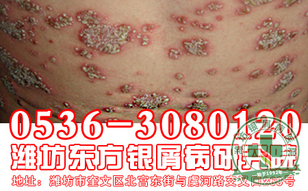 银屑病吃什么食物对病情有好处?